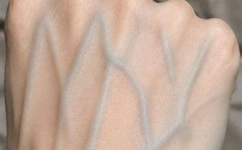 Featured image for Visible Veins on Your Hands? Here’s What They Coul